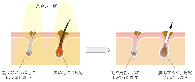 通常の脱毛とWAX脱毛の違い