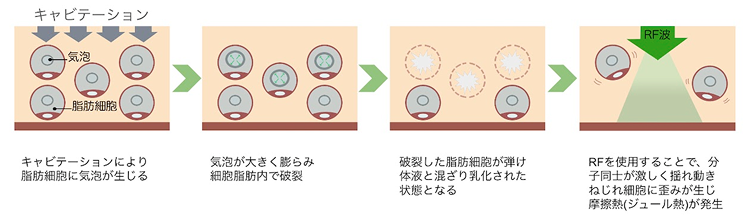 キャビテーションとは