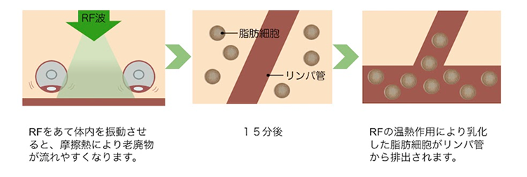 軟部組織リリースの施術