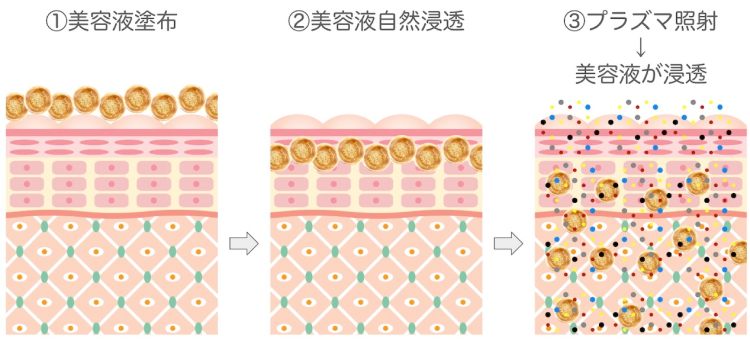 水光プラズマフェイシャルの仕組み①