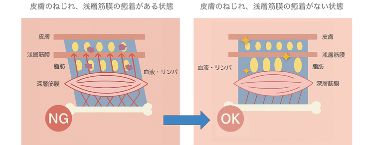 皮膚のねじれ、浅層筋膜の癒着がある可能性があります